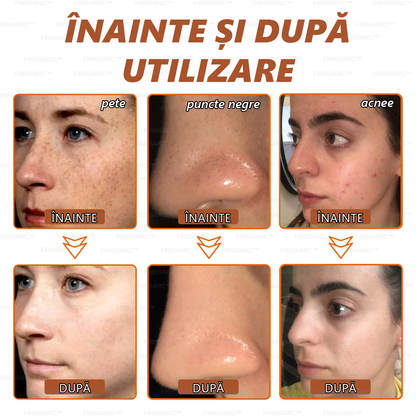 💟FRISSARC™ masca facială  pentru albire și îndepărtarea petelor –🍀Ingredientele naturale ajută la eliminarea eficientă și de durată a petelor pigmentare, petelor de vârstă, pistruilor și petelor solare.🔥🔥