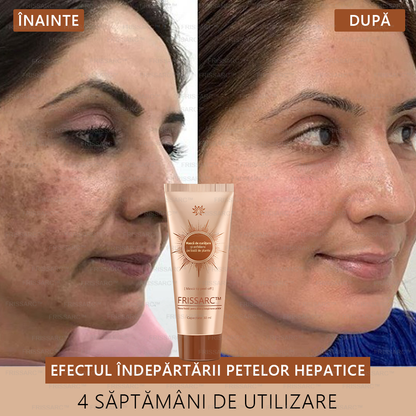 💟FRISSARC™ masca facială  pentru albire și îndepărtarea petelor –🍀Ingredientele naturale ajută la eliminarea eficientă și de durată a petelor pigmentare, petelor de vârstă, pistruilor și petelor solare.🔥🔥