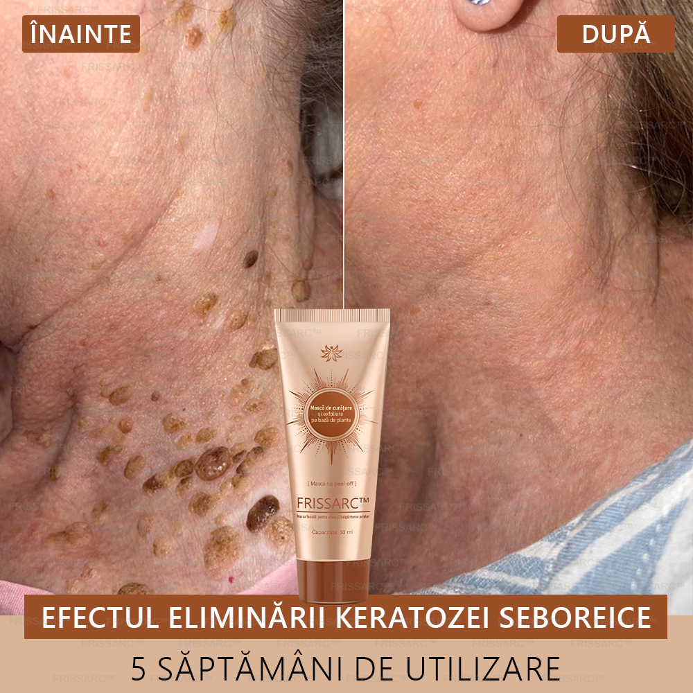 💟FRISSARC™ masca facială  pentru albire și îndepărtarea petelor –🍀Ingredientele naturale ajută la eliminarea eficientă și de durată a petelor pigmentare, petelor de vârstă, pistruilor și petelor solare.🔥🔥