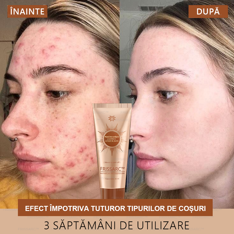 🎁 Felicitări! Te numeri printre primele 200 de comenzi! Profită acum de o reducere suplimentară de 50%! Acționează acum pentru a avea grijă de sănătatea pielii tale. Dacă ratezi această ocazie, la anul s-ar putea să nu mai existe! 🎁 Grăbește-te!