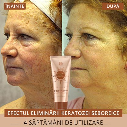 💟FRISSARC™ masca facială  pentru albire și îndepărtarea petelor –🍀Ingredientele naturale ajută la eliminarea eficientă și de durată a petelor pigmentare, petelor de vârstă, pistruilor și petelor solare.🔥🔥